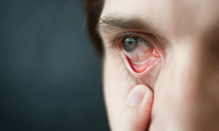 Recreational Marijuana Abuse Recreational Marijuana Abuse